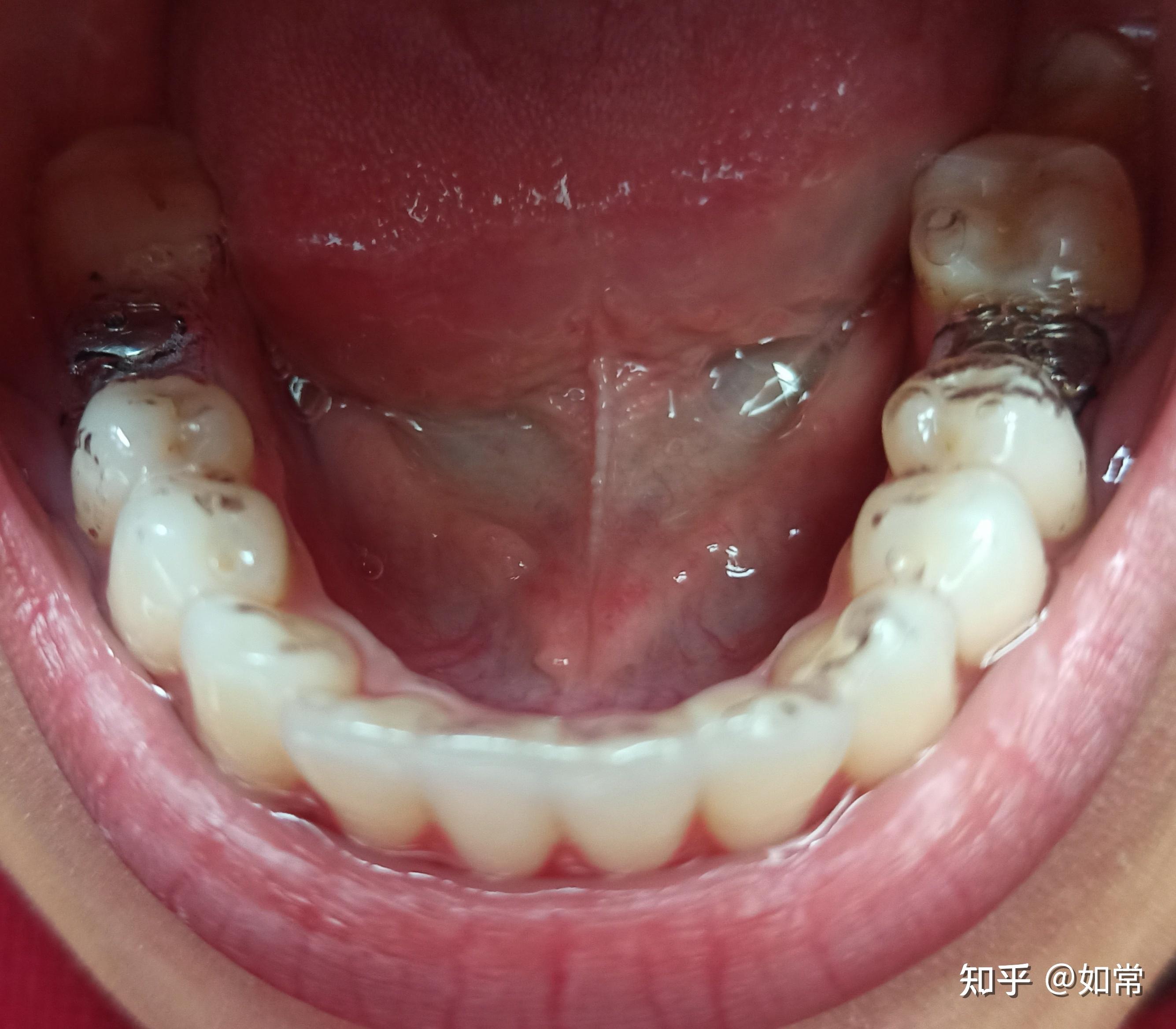 种牙二期安愈合基台 - 知乎