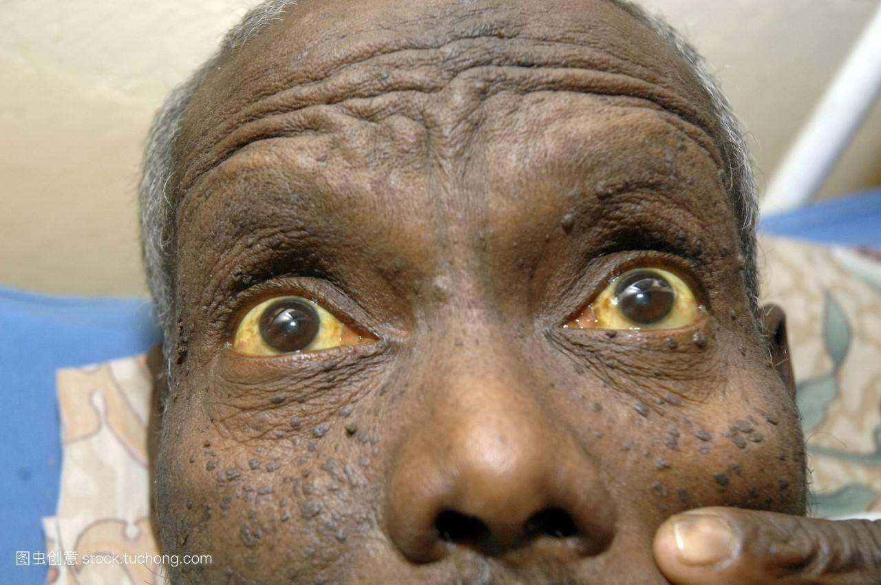 根据眼睛眼白颜色的变化来看背后的病变情况 知乎