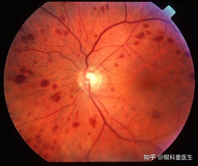 与系统性疾病相关的视网膜病变——5,眼缺血综合征