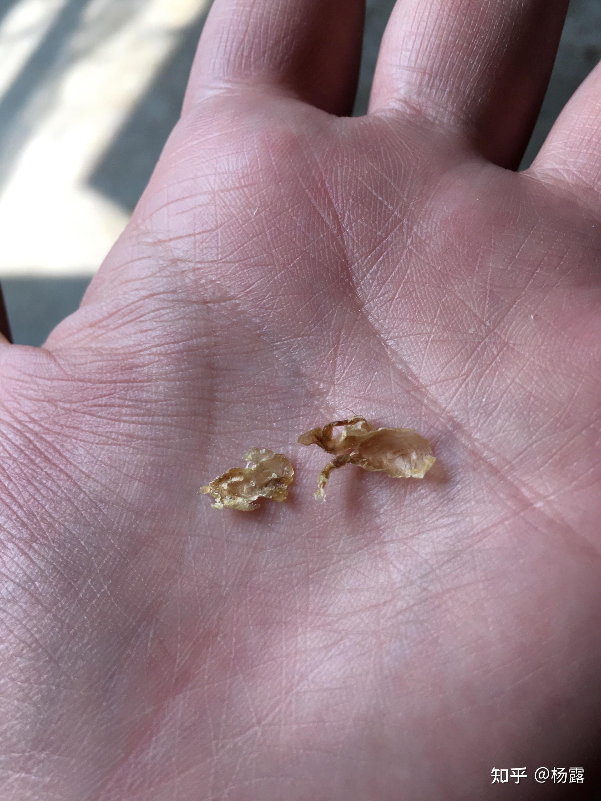 为什么我掏出来的耳屎是桶状的,就是一层薄膜粘附在耳壁上? - 知乎