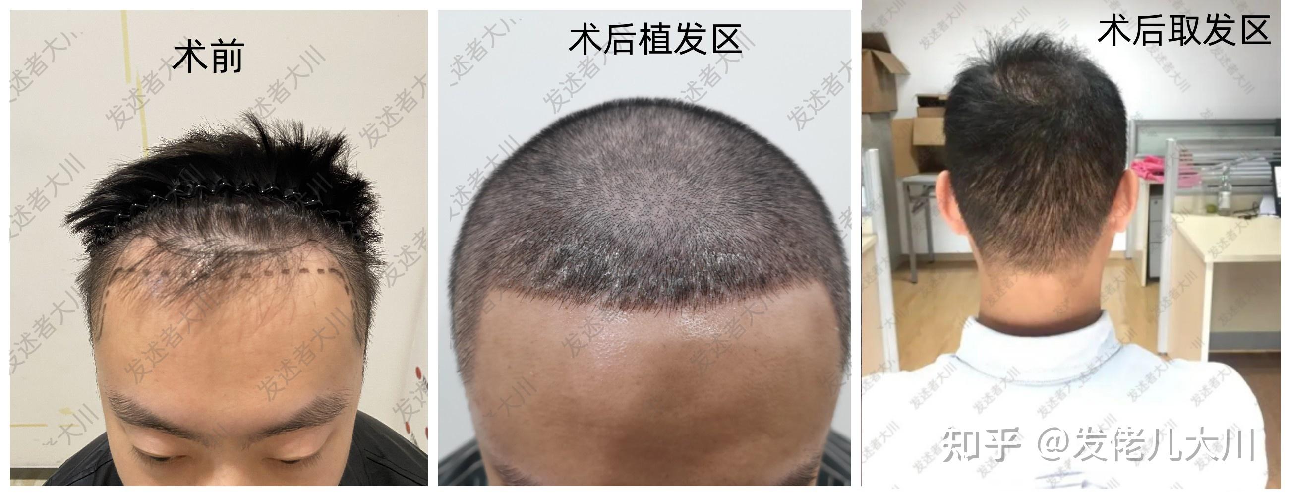 长期自己去植发(长期自己去植发会怎么样)