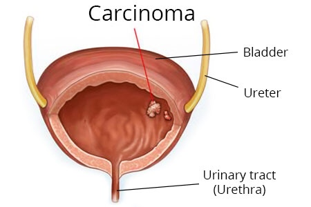 膀胱癌示意图图片