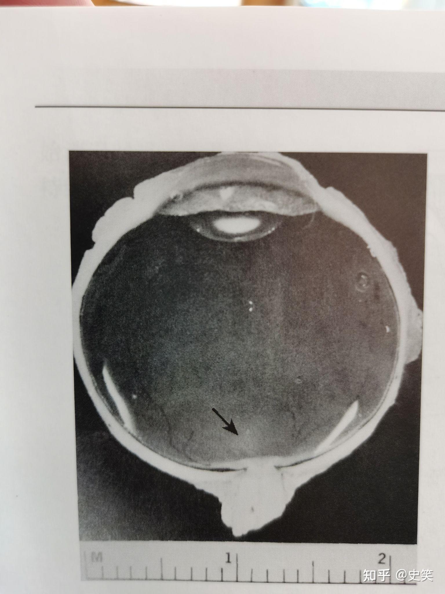 玻璃体液化怎么办