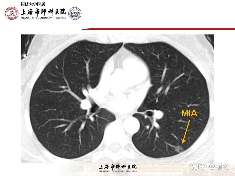 元芳,你看,mia是非常早期的非小細胞肺癌,mia的定義是指病灶≤3 cm