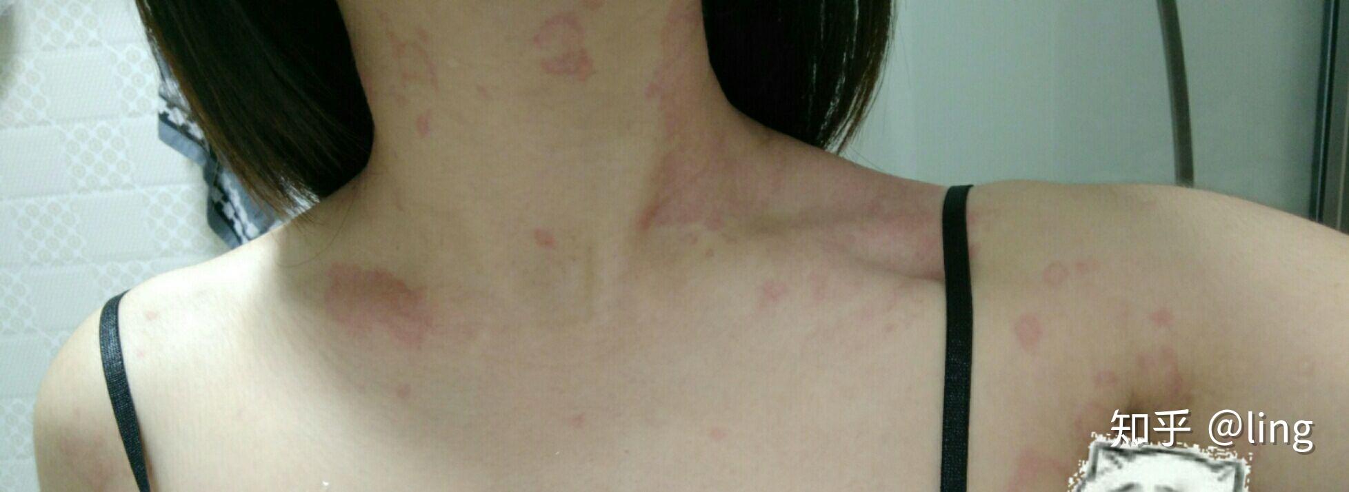 大半夜荨麻疹发作超吓人