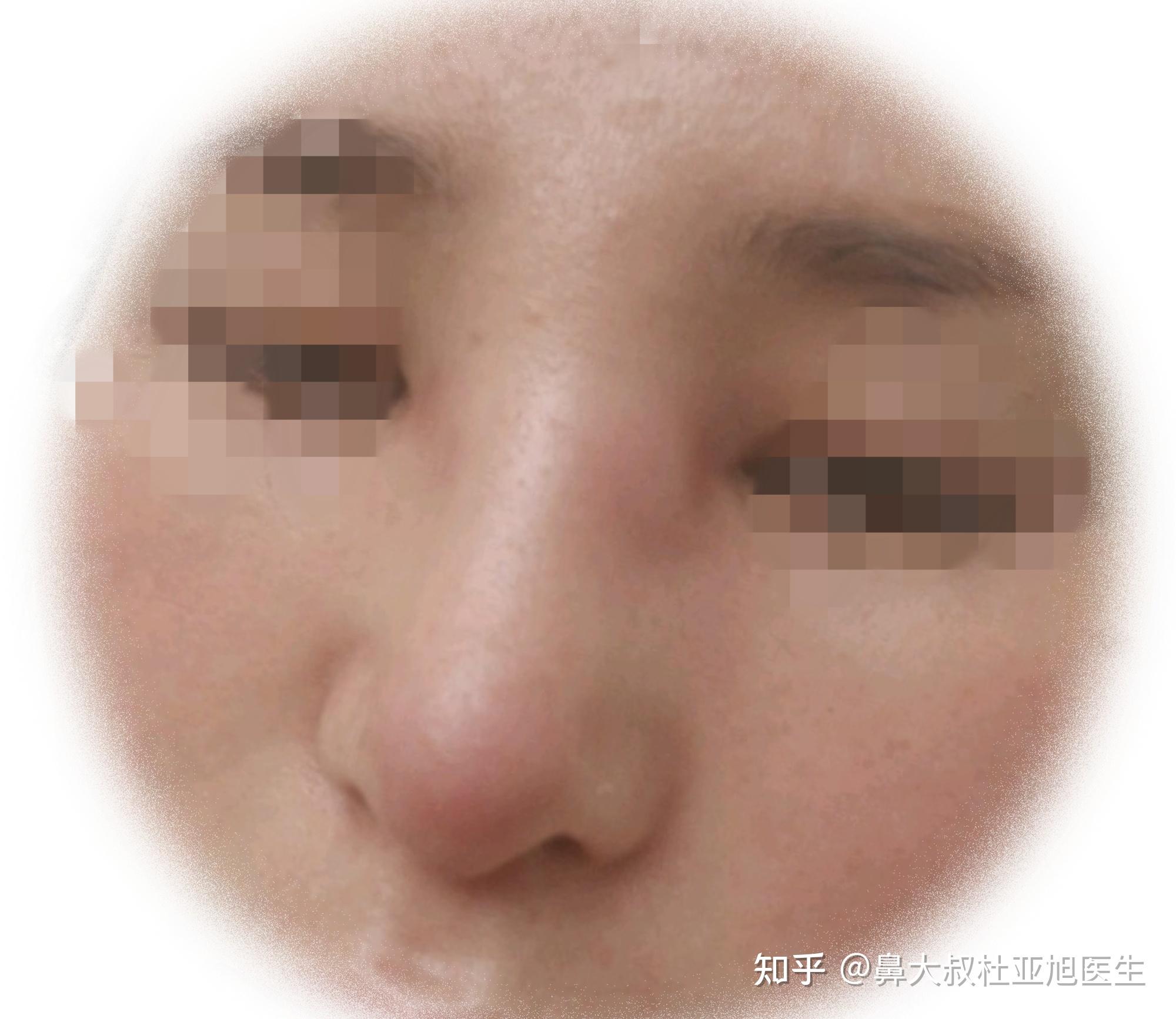 隆鼻术后鼻子山根处鼻梁的小鼓包是什么情况