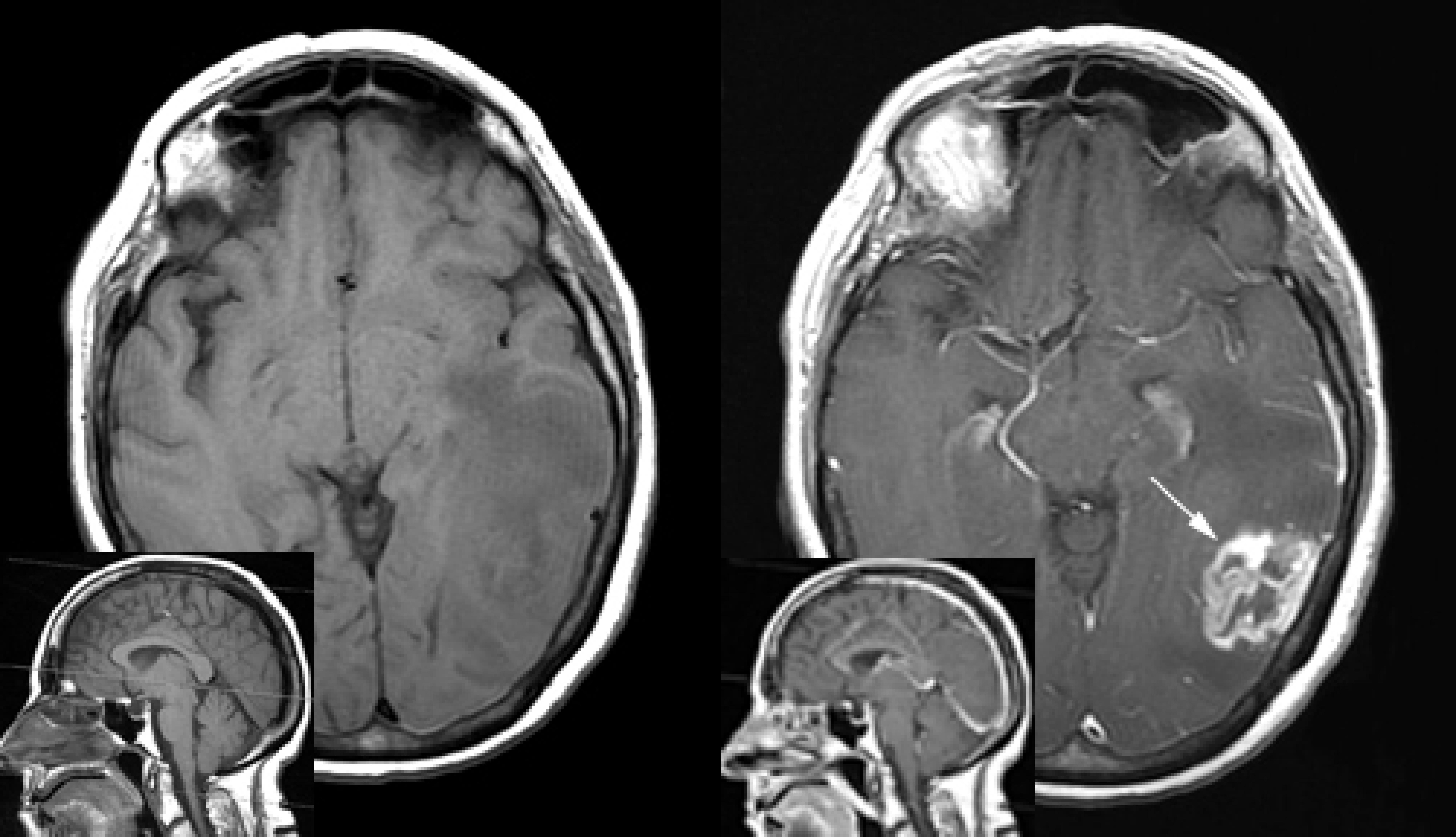 Neuro-Oncology：对脑胶质瘤IDH突变状态进行分类的一种基于MRI的全自动深度学习算法 - 知乎