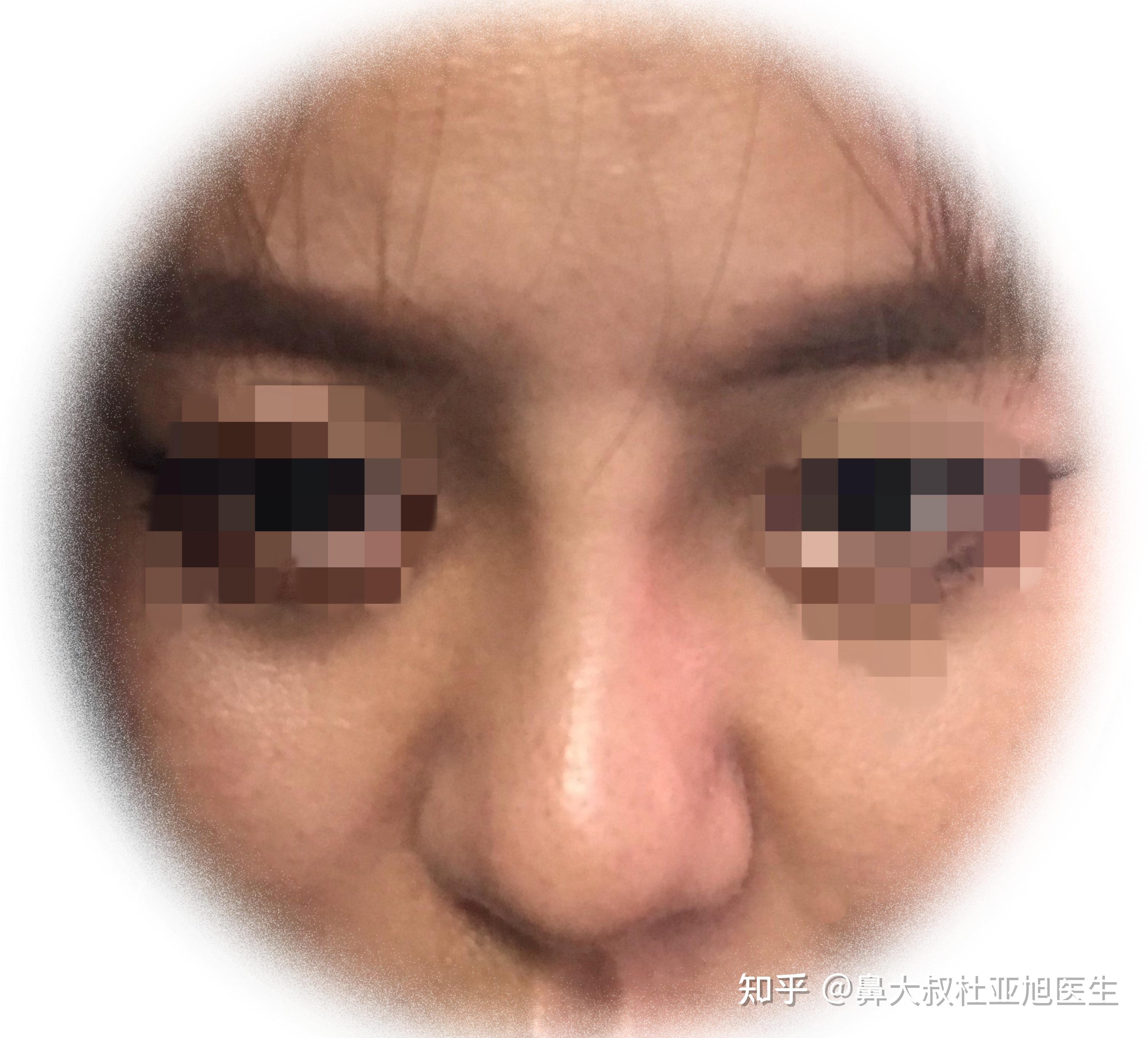 隆鼻术后鼻子山根处鼻梁的小鼓包是什么情况