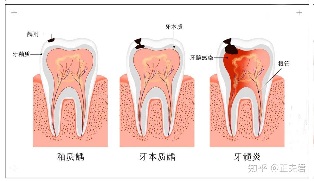 牙髓组织图片