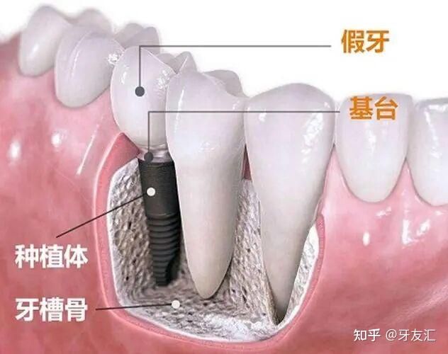 牙槽嵴顶线图片