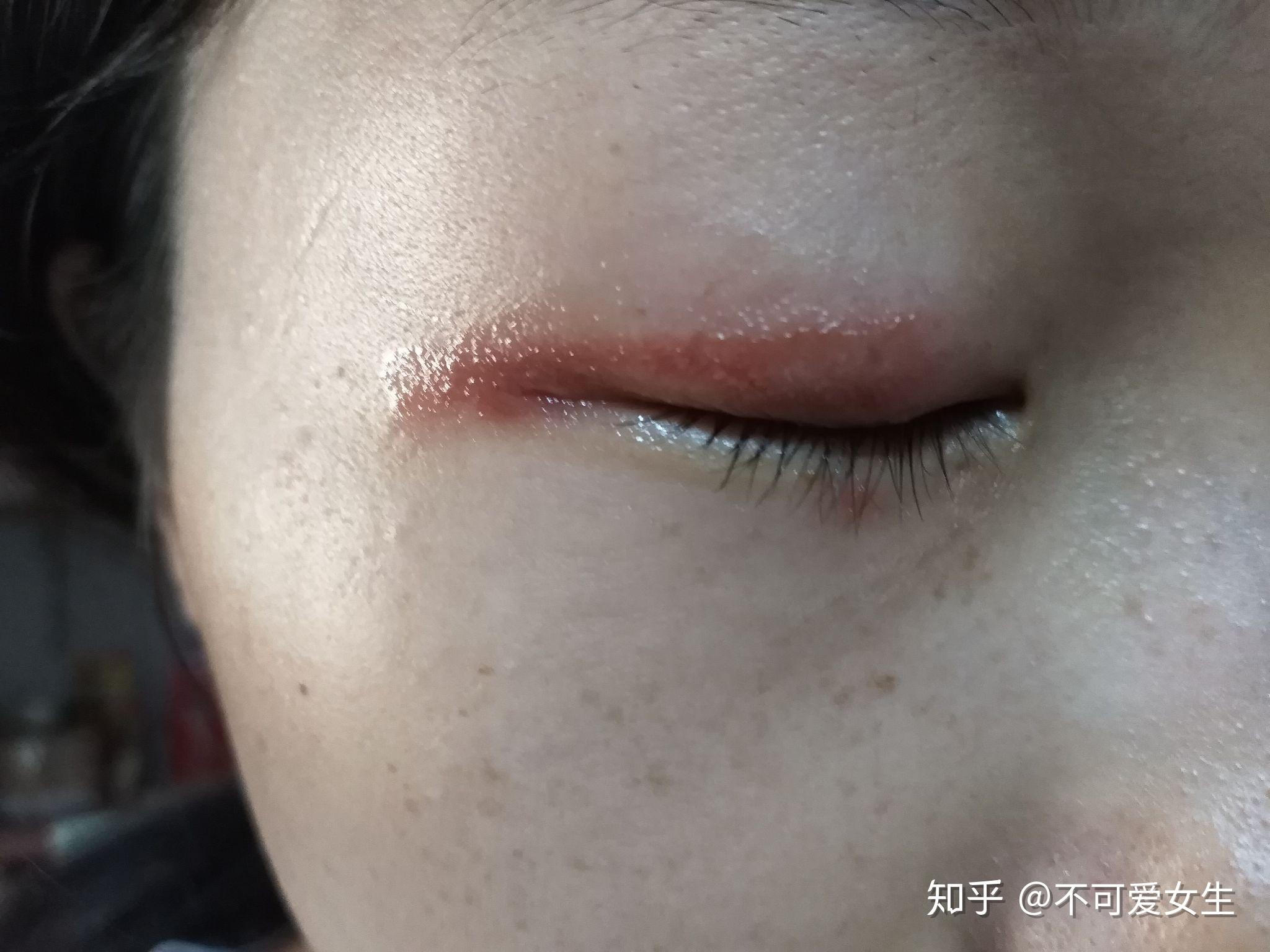 被隐翅虫的毒液给伤害了脖子受伤会留疤吗