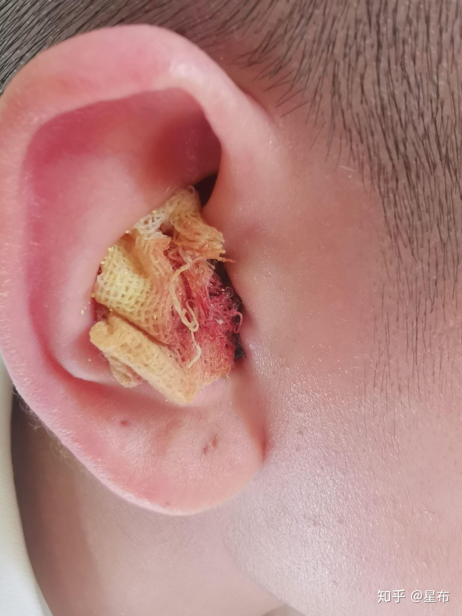 鼓膜穿孔修补手术有人了解么?具体有哪些风险? - 知乎