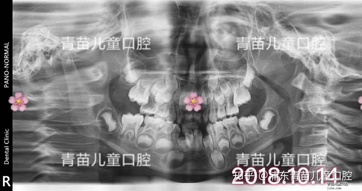 被家长耽误掉看牙黄金期宝贝的真实案例
