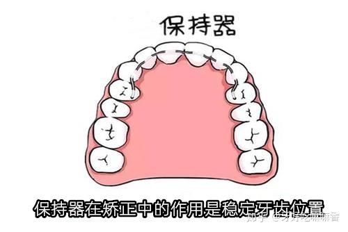 如何保证牙齿矫正结束后不复发?