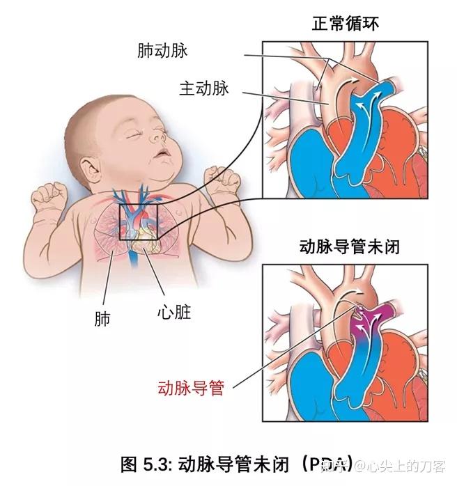 动脉导管未闭有图讲解图片