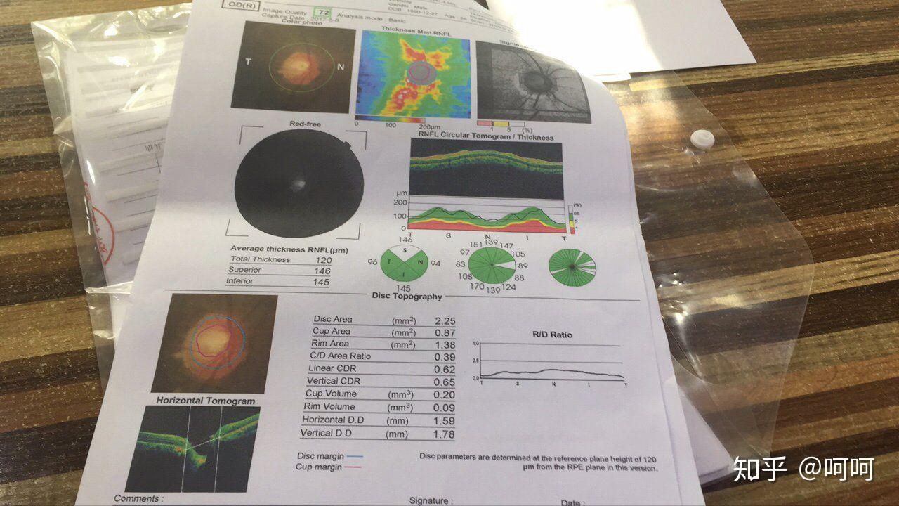 眼科oct报告图图片