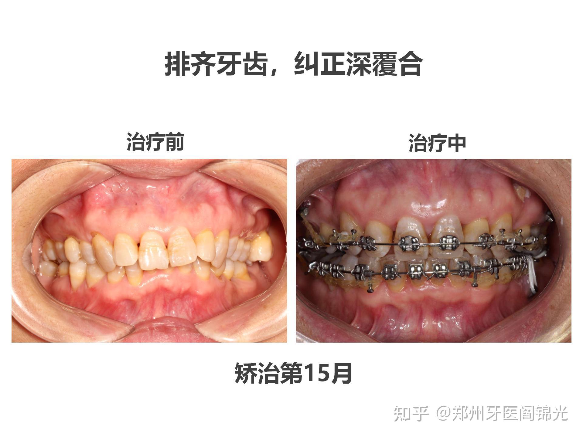 50岁,凸面形伴下颌发育不足,牙齿拥挤不齐,左侧后牙正锁合的固定矫治