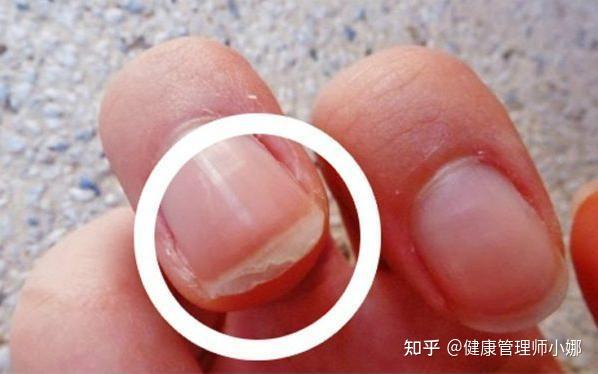 手掌正常吗,是不是肝掌? - 知乎