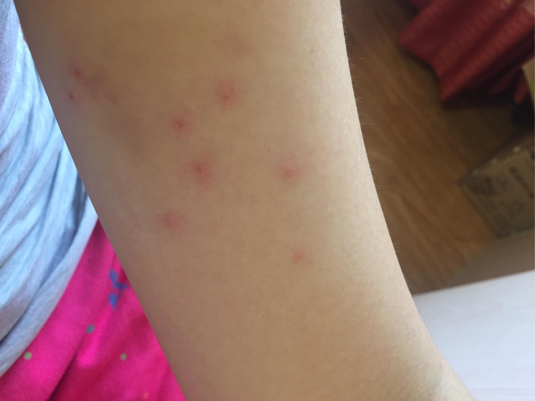 人被猫癣传染的治疗经验