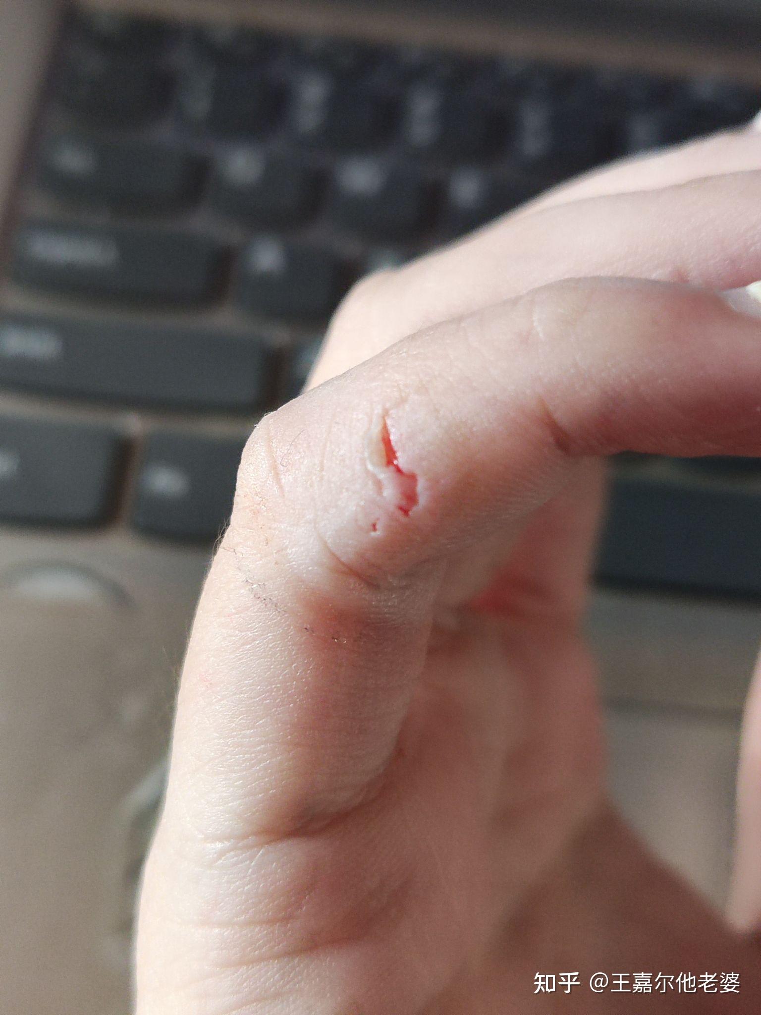 这样需不需要打破伤风针?