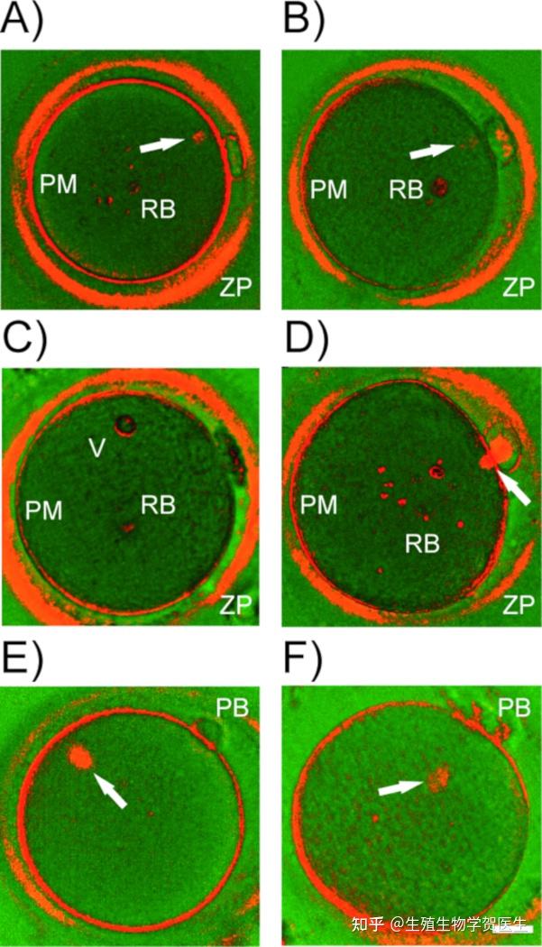 死扣试管婴儿成功率实验室技术篇无创纺锤体成像改善受精结果