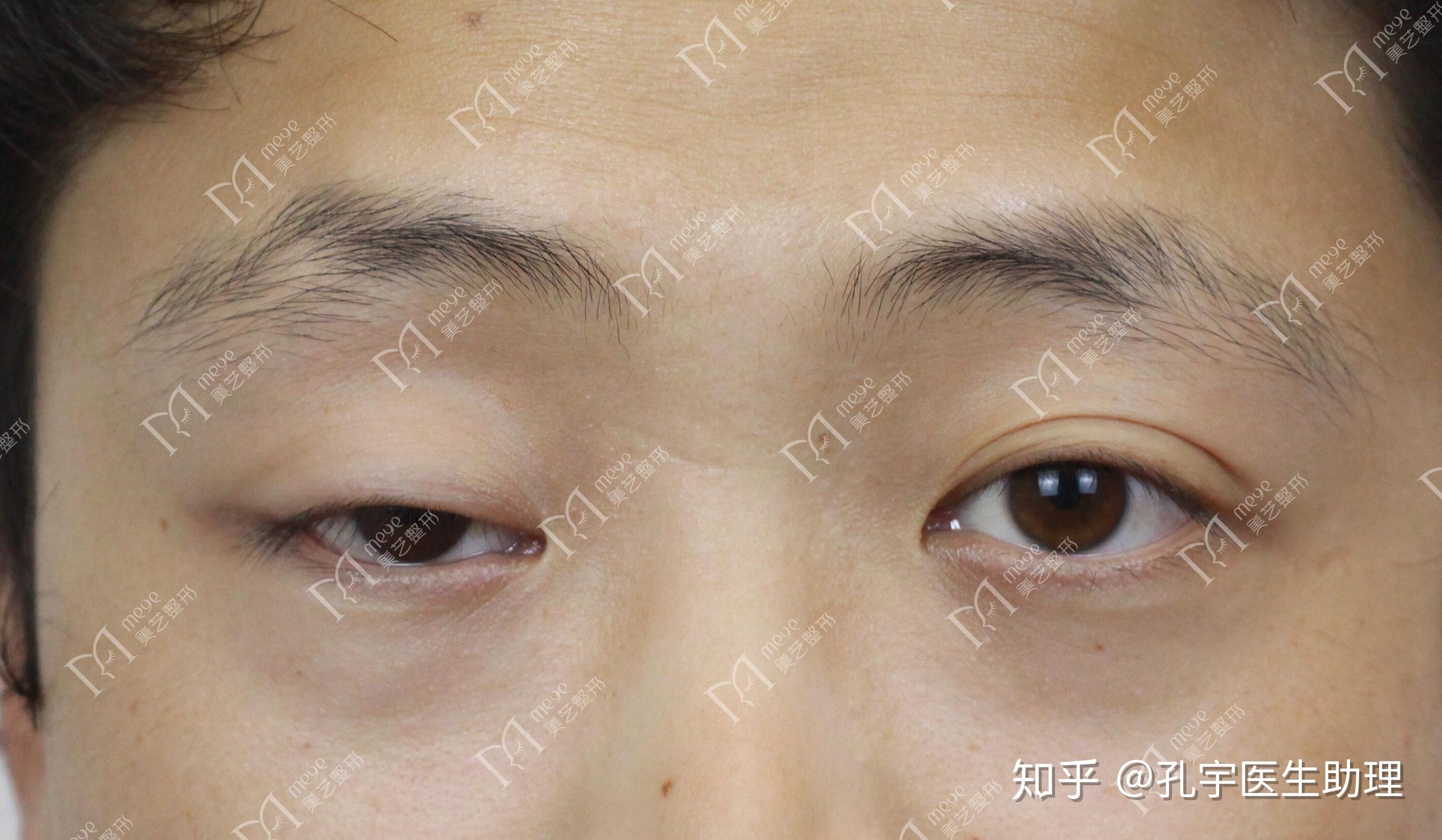 如图左右眼不对称怎么办?