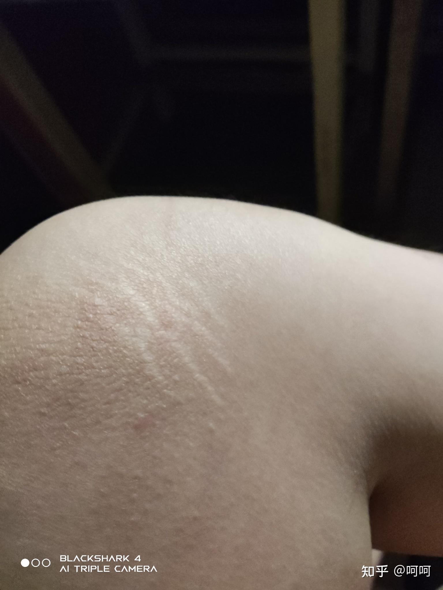 一直很好奇膝盖旁边长的这种纹路到底是什么