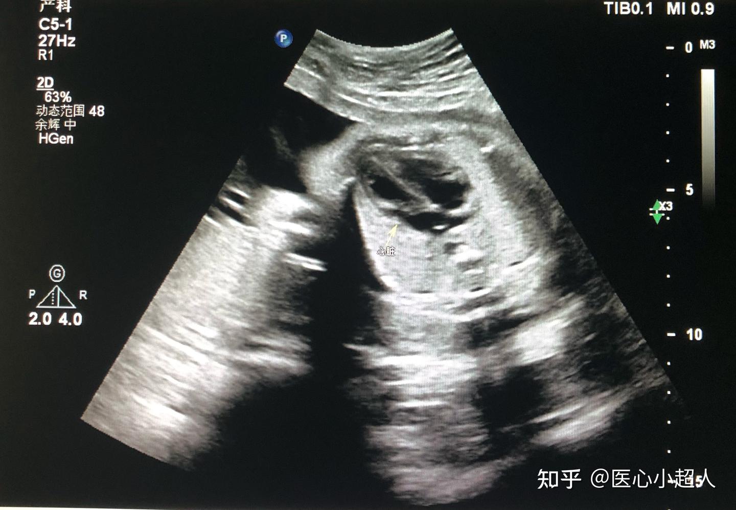 中晚期妊娠胎儿超声解剖特点- 知乎
