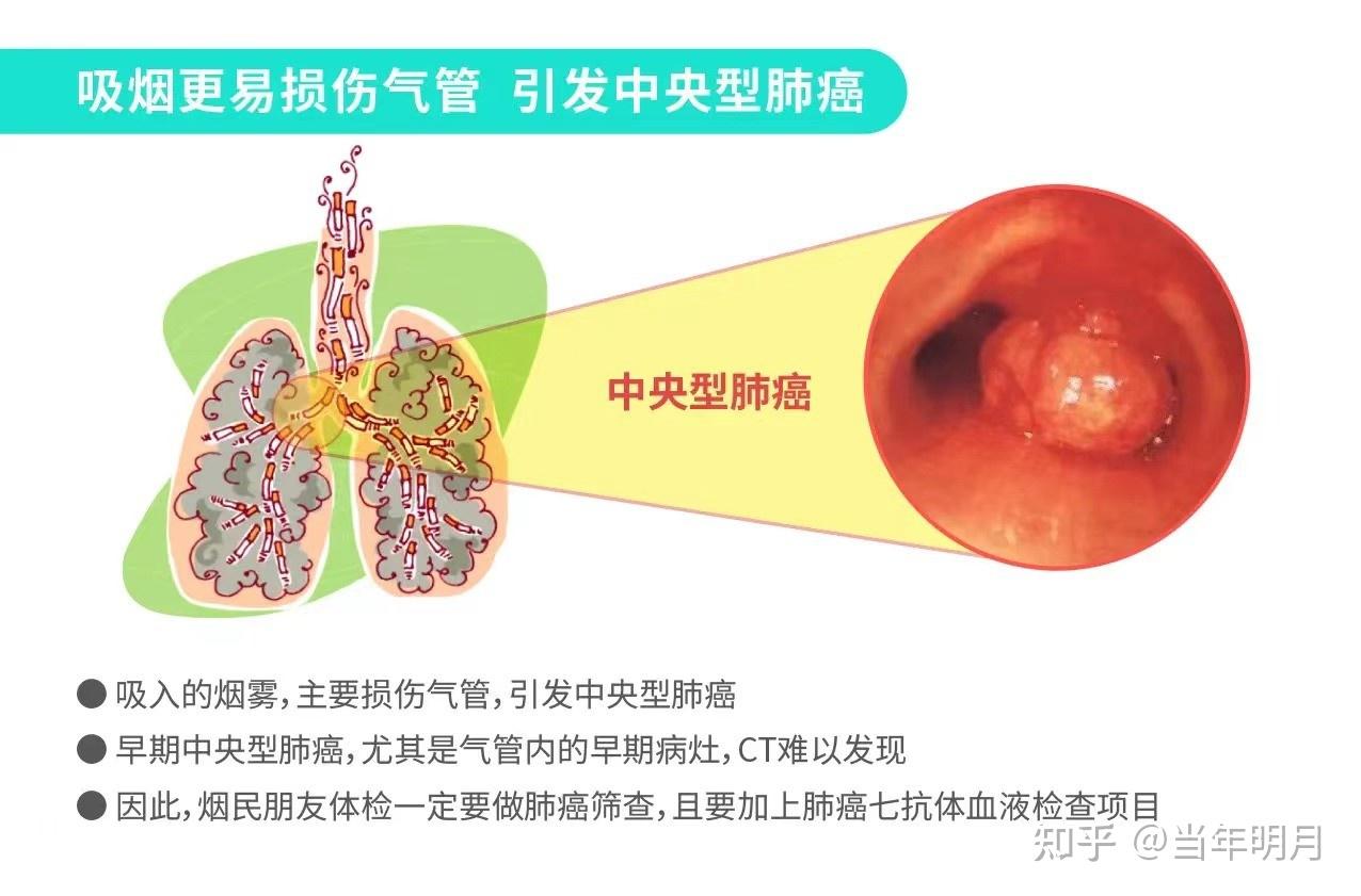 中央型肺癌图片