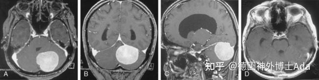 脑膜瘤的临床表现有哪些？详细解读不同位置脑膜瘤症状 知乎