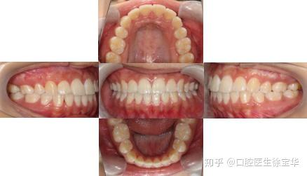 正畸治疗中常以andrews的正常合六标准作为牙齿咬合的治疗目标.