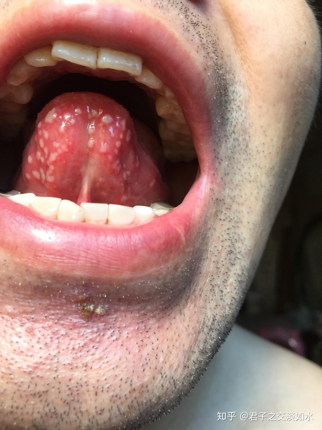 舌头溃疡白色图片