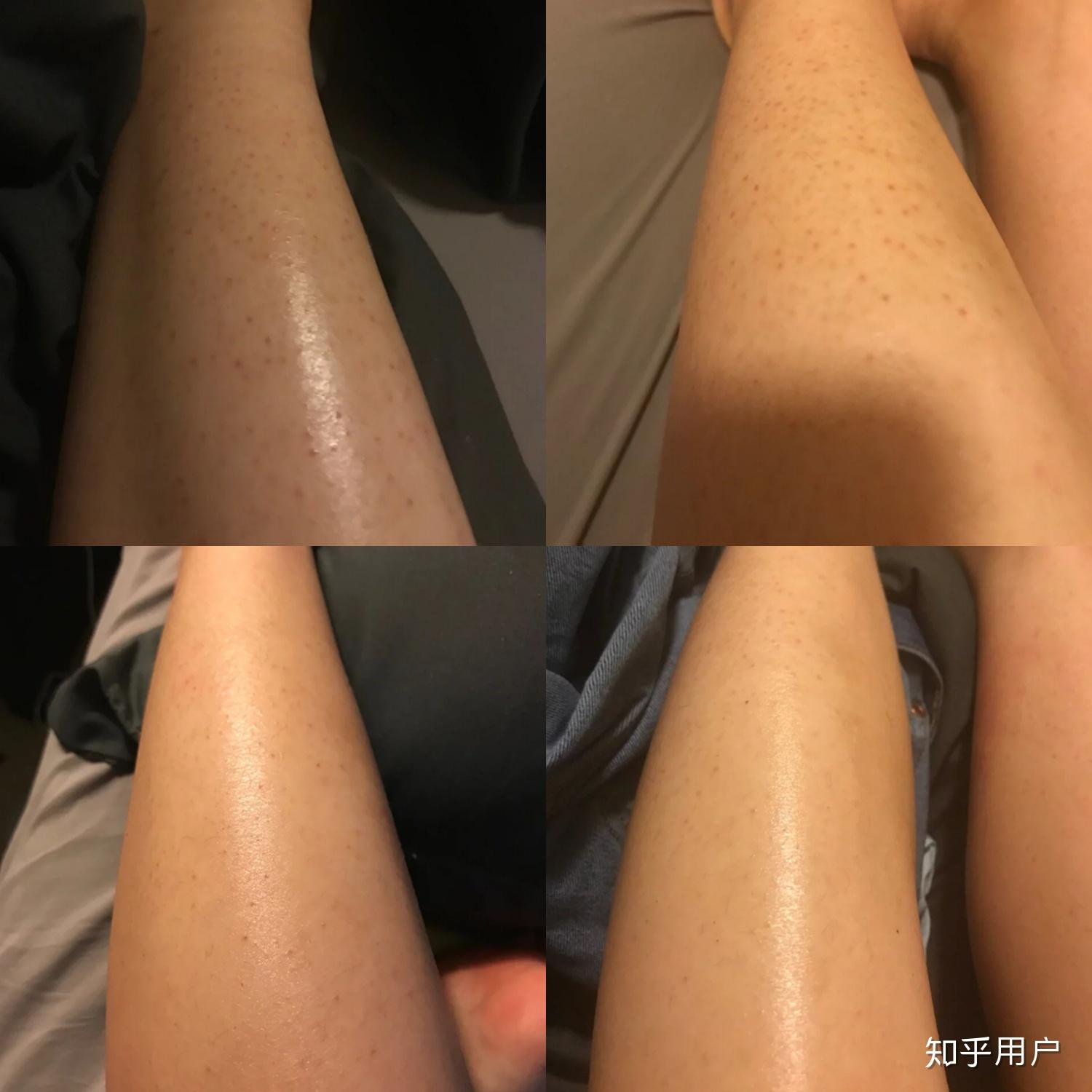 鸡皮肤越来越差(为什么鸡皮肤越来越严重 我来告诉你)