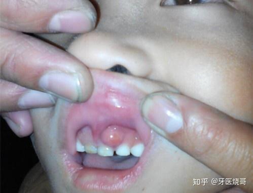 牙龈上长了一个脓包怎么办? - 知乎