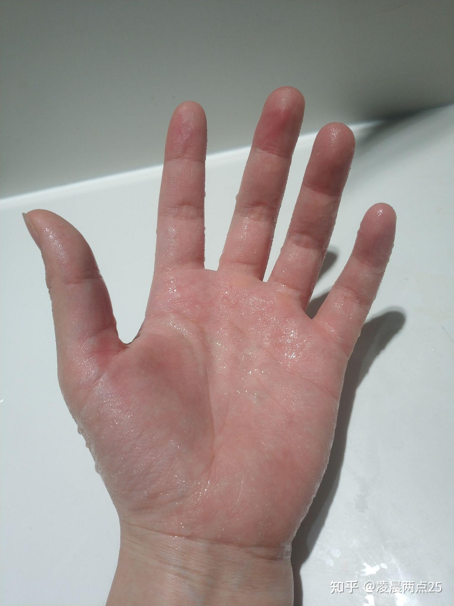 31年多汗症患者下定决心改变人生