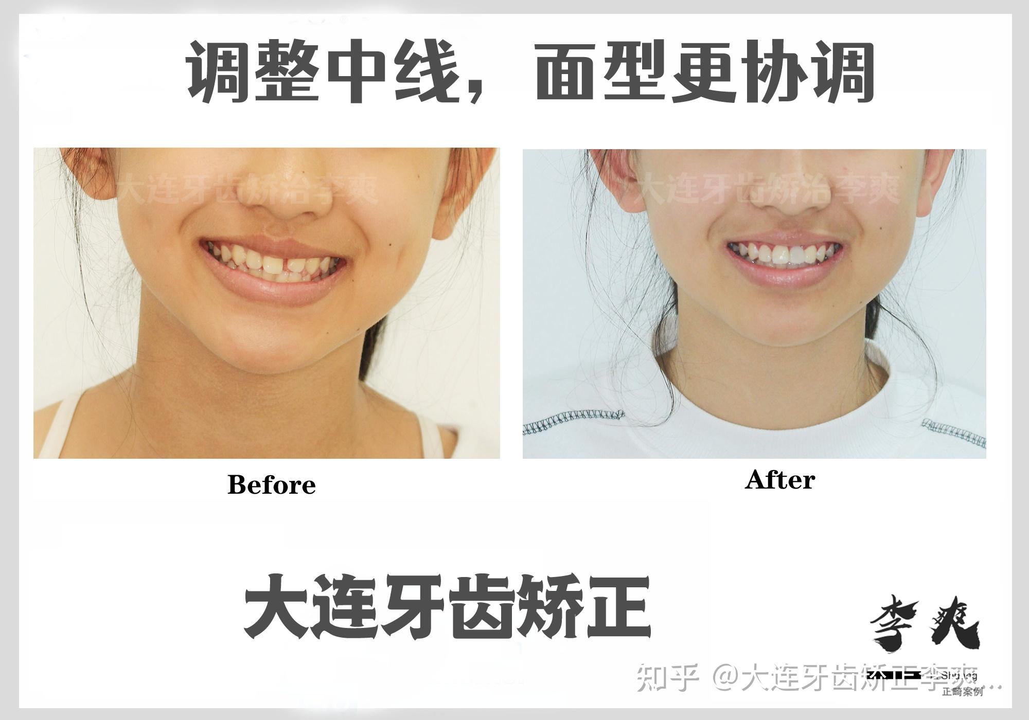 矫正牙齿能做到完美吗还是一定会有瑕疵
