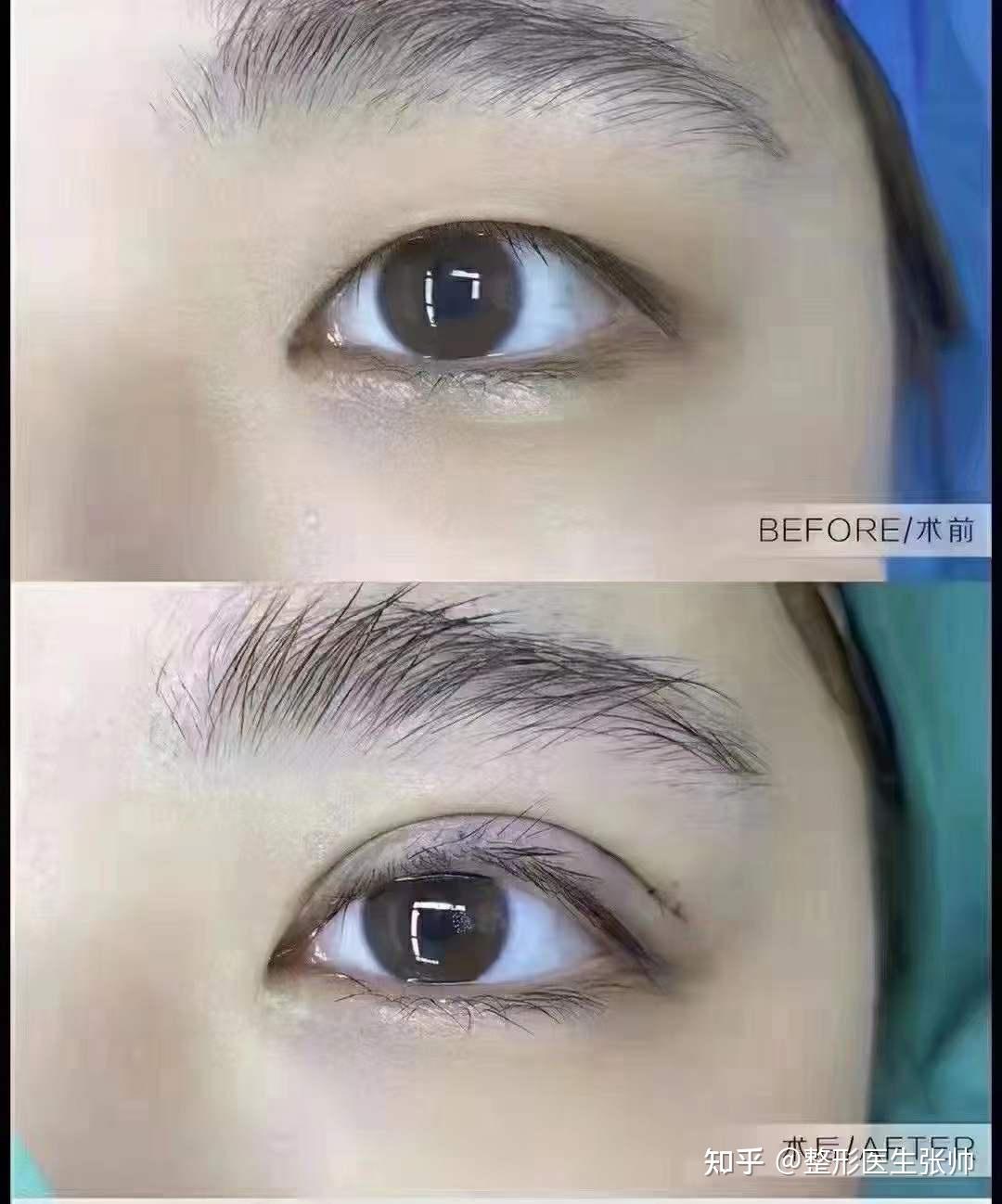 内双与单眼皮割双眼皮有不同吗?一单一双能只做一边吗? - 知乎