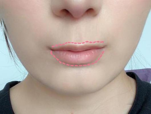 上海九院孙沣博士人中缩短听说很容易留疤到底能不能做啊