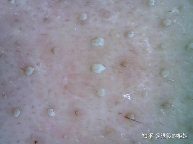白头粉刺能治愈么