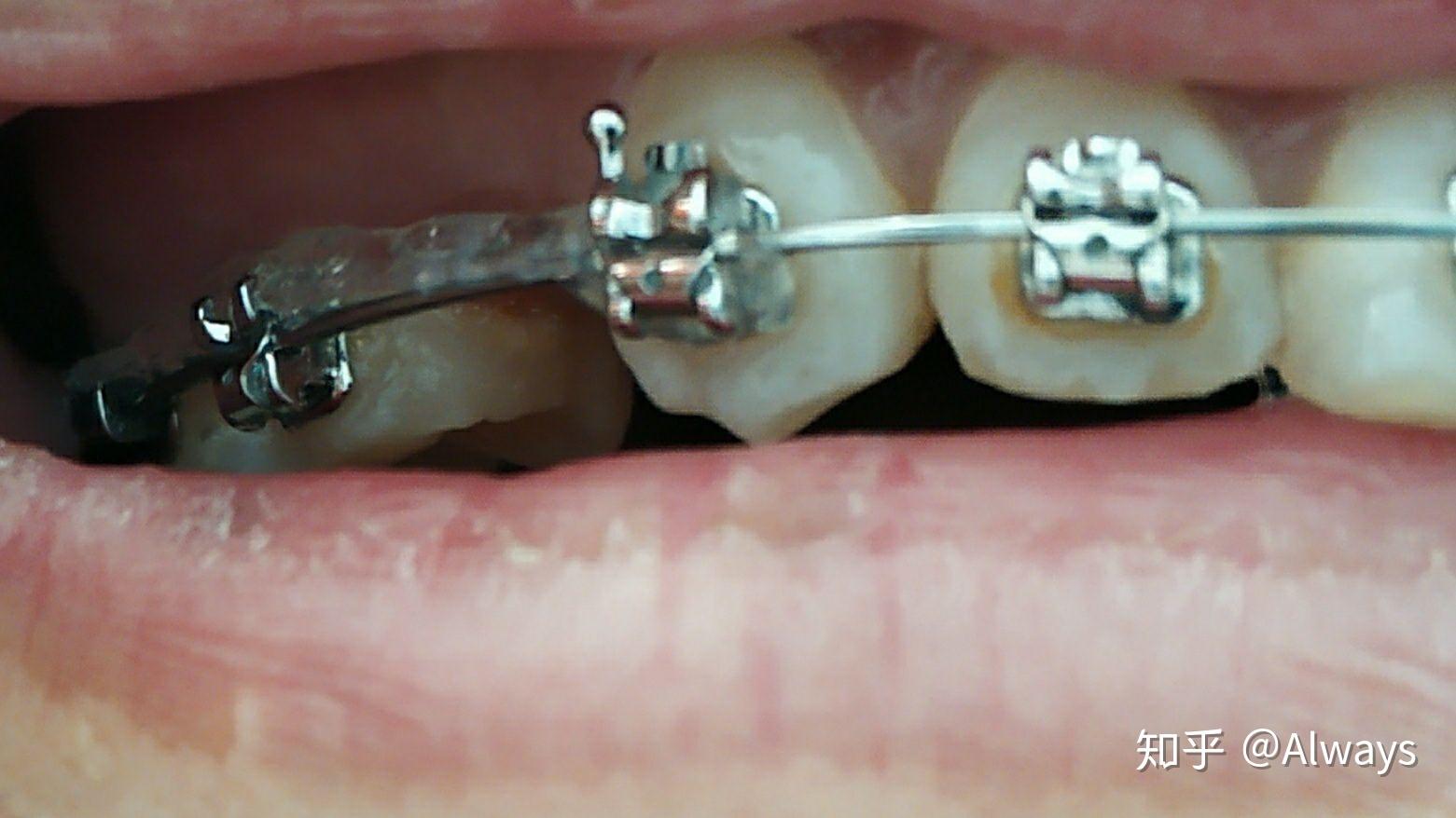 正畸矫正22岁带自锁牙套的全过程