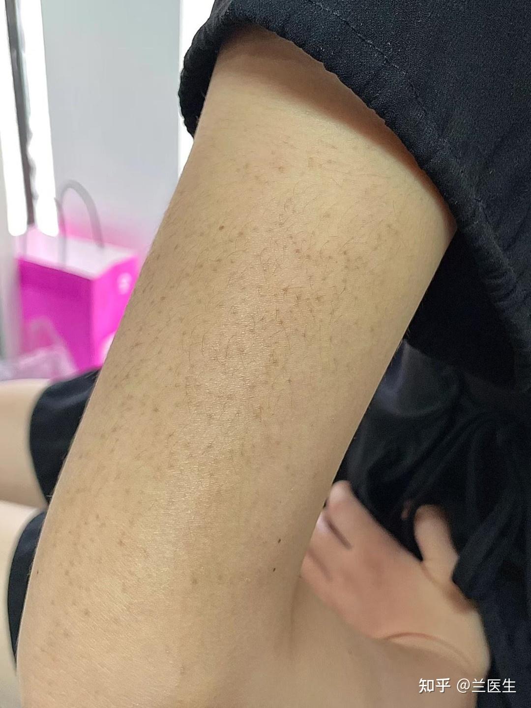 胳膊上这是鸡皮吗? - 知乎