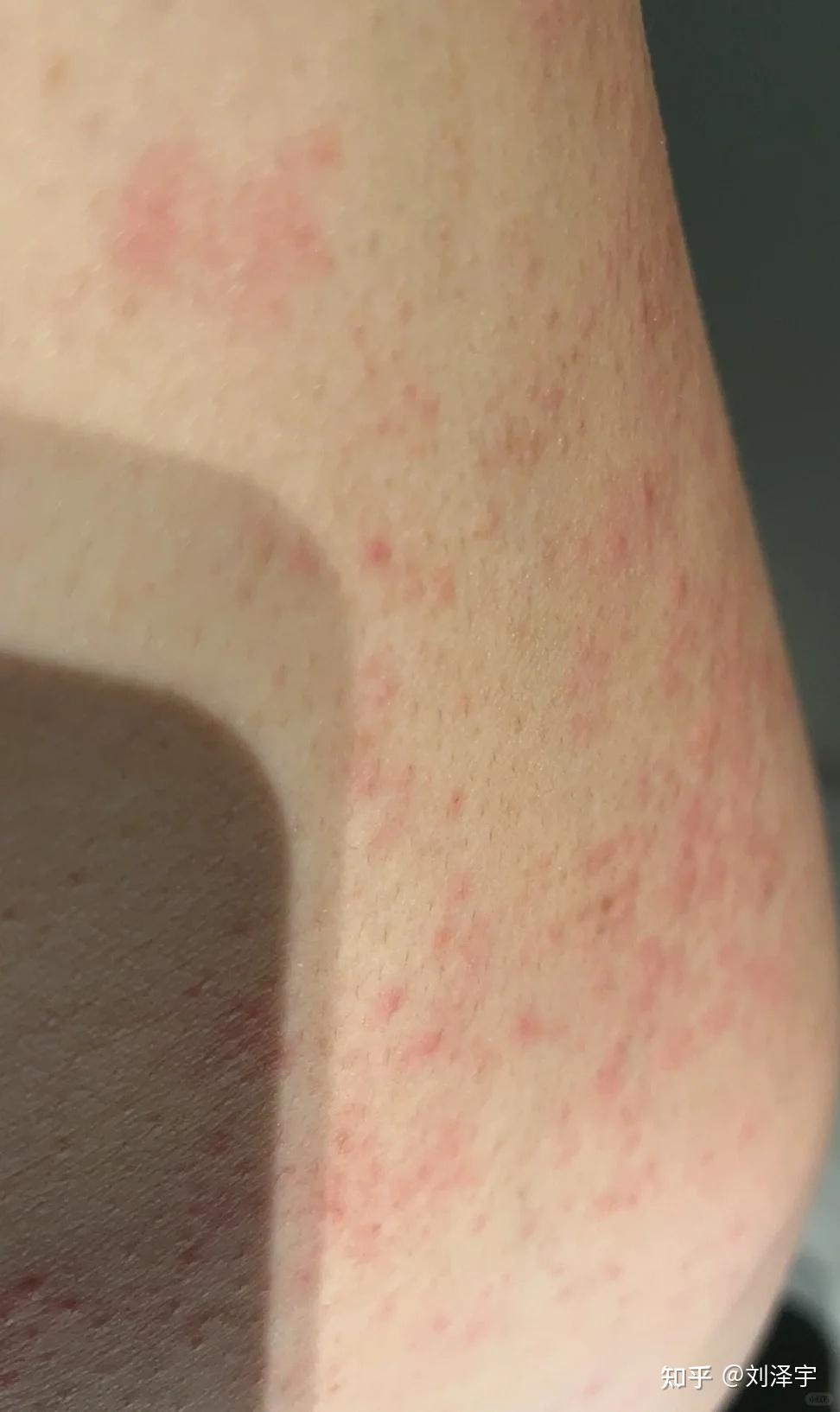 男生私密处和大腿根起一些红色的疹子还很痒是怎么回事? - 知乎