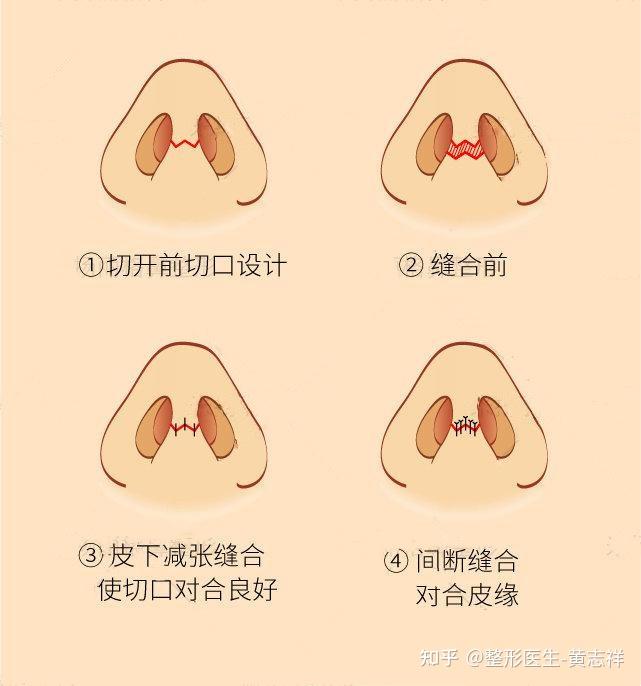 隆鼻手术切口会不会很明显