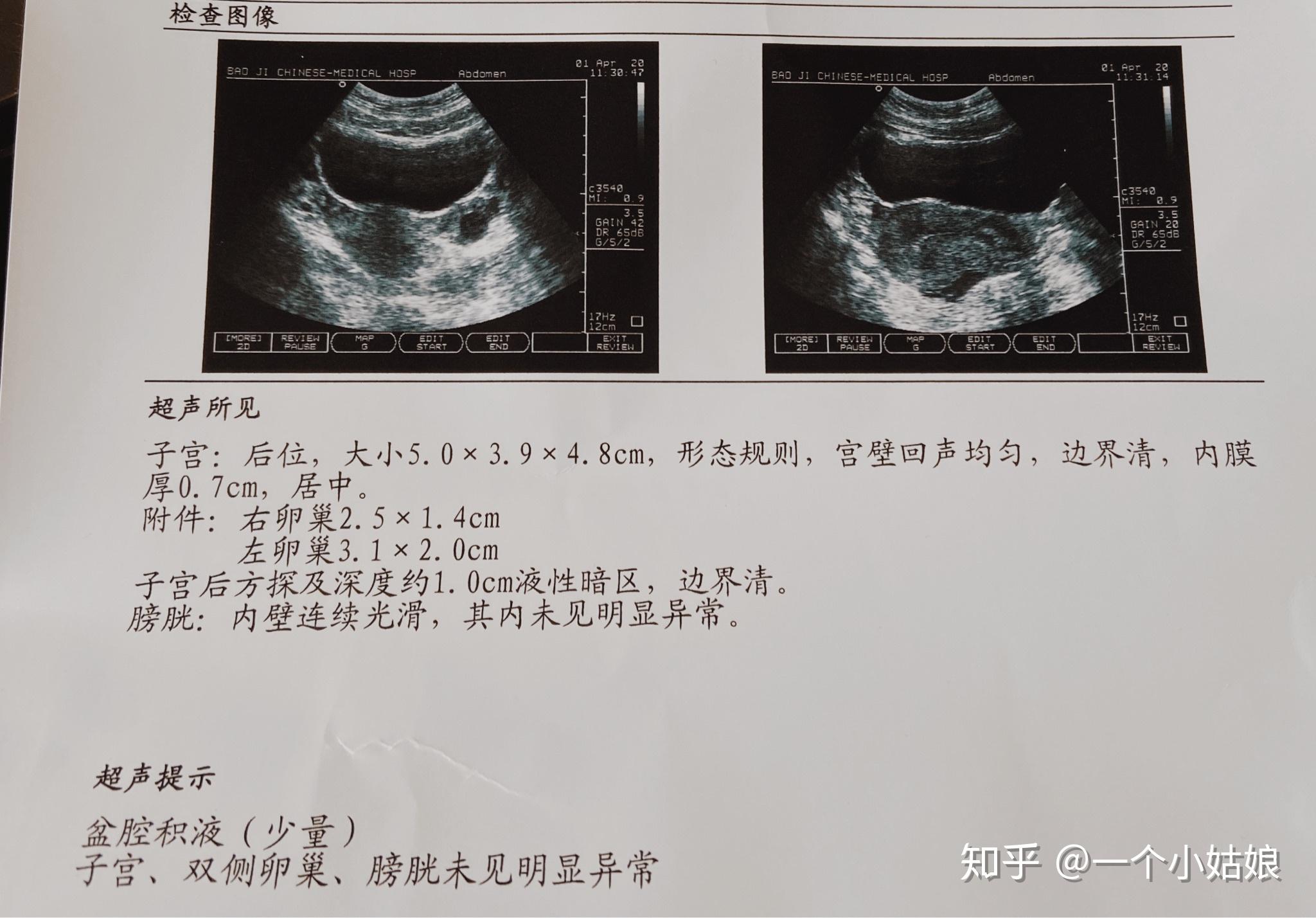 黄陂区中医医院实施多科联动诊疗模式 成功完成一例子宫动脉栓塞术应用瘢痕妊娠治疗