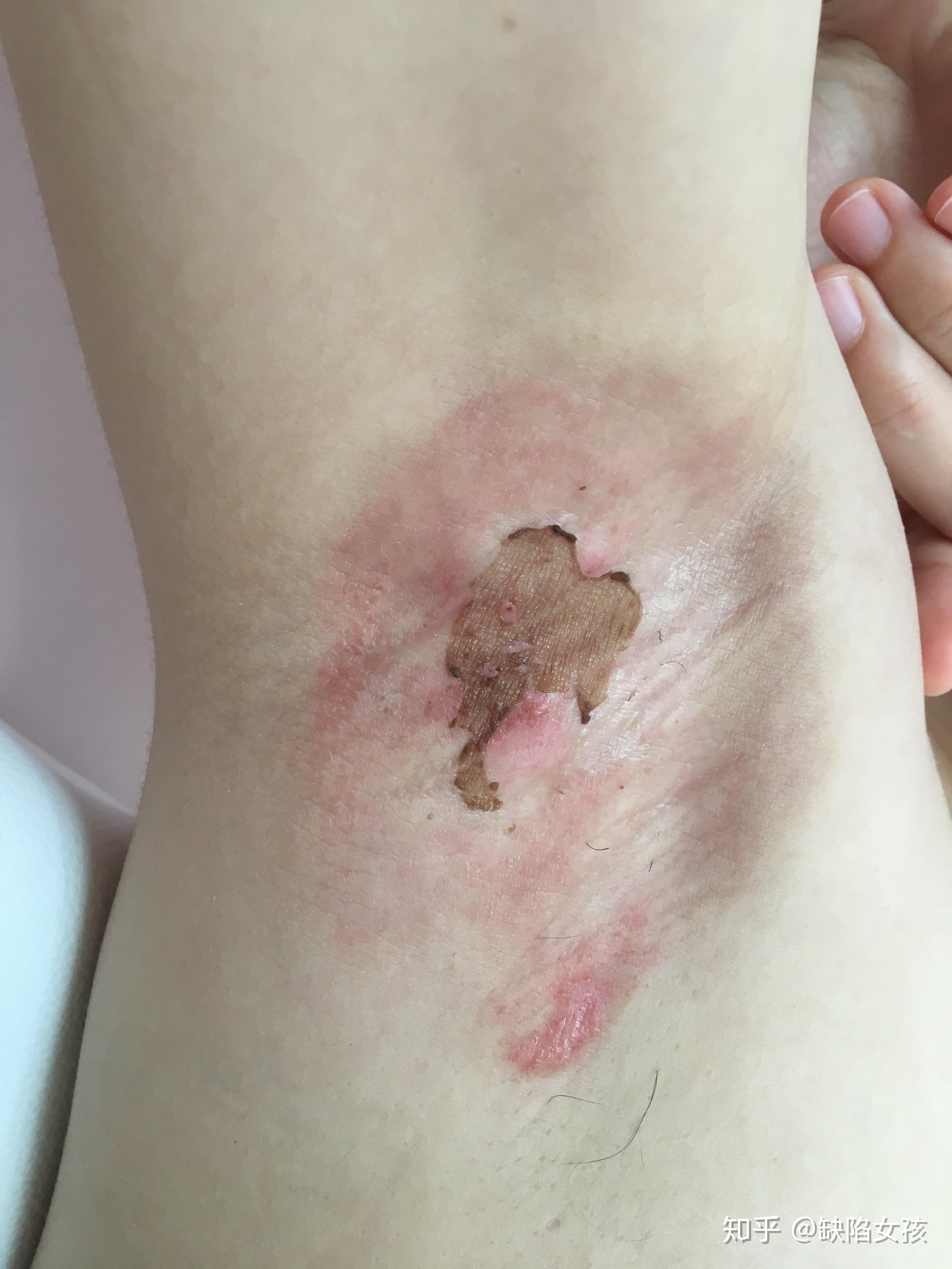 腋臭手术疤痕(微创)持续更新