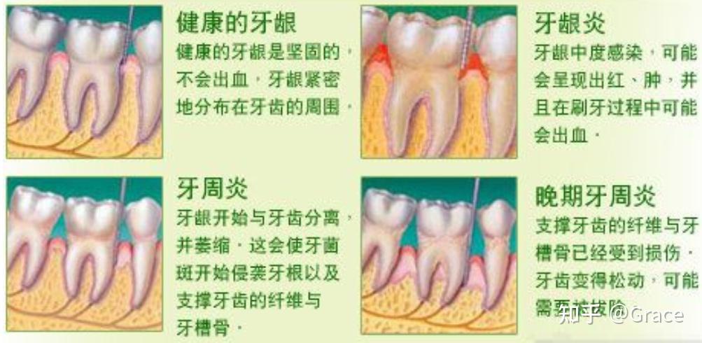 科普-牙周炎及治疗 - 知乎