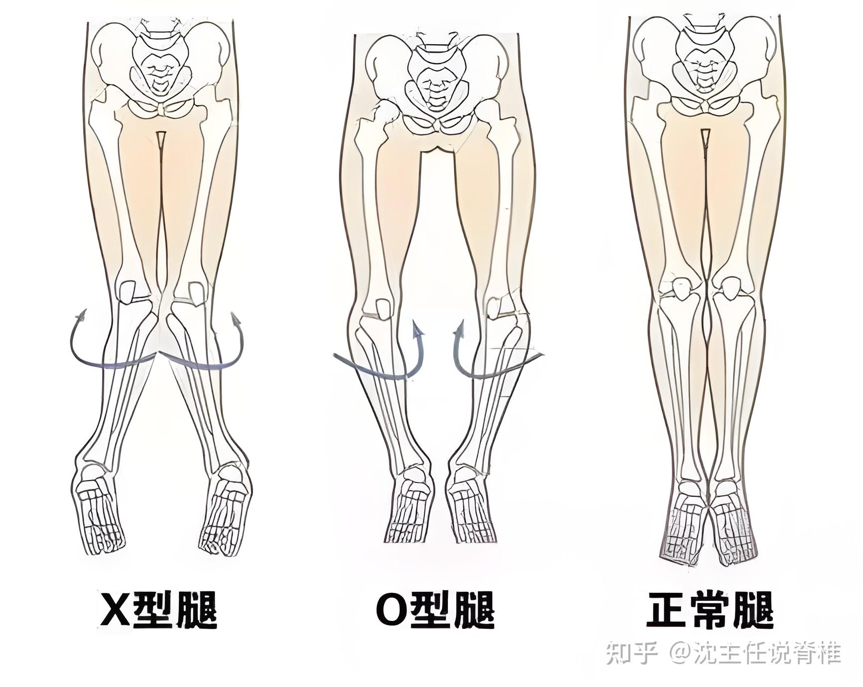 长短腿的原因图片