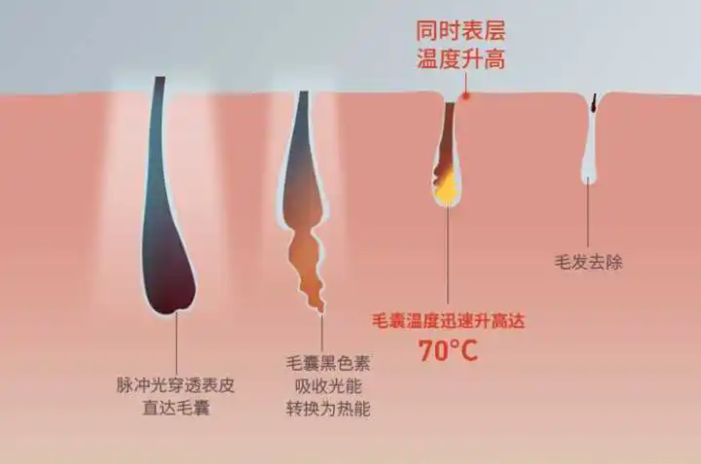 ipl脱毛技术是不是智商税?