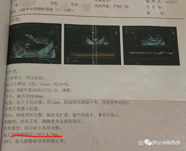 Nt增厚别慌 检查5 1mm的经历告诉你很可能只是虚惊一场 知乎