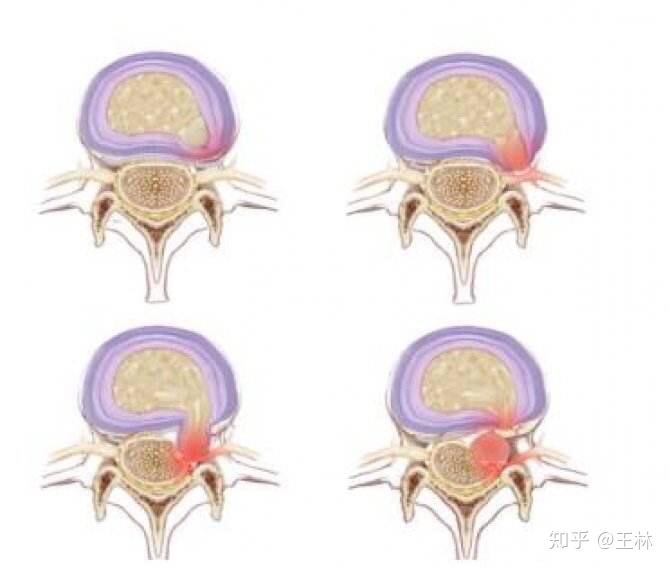 髓核凸出图片